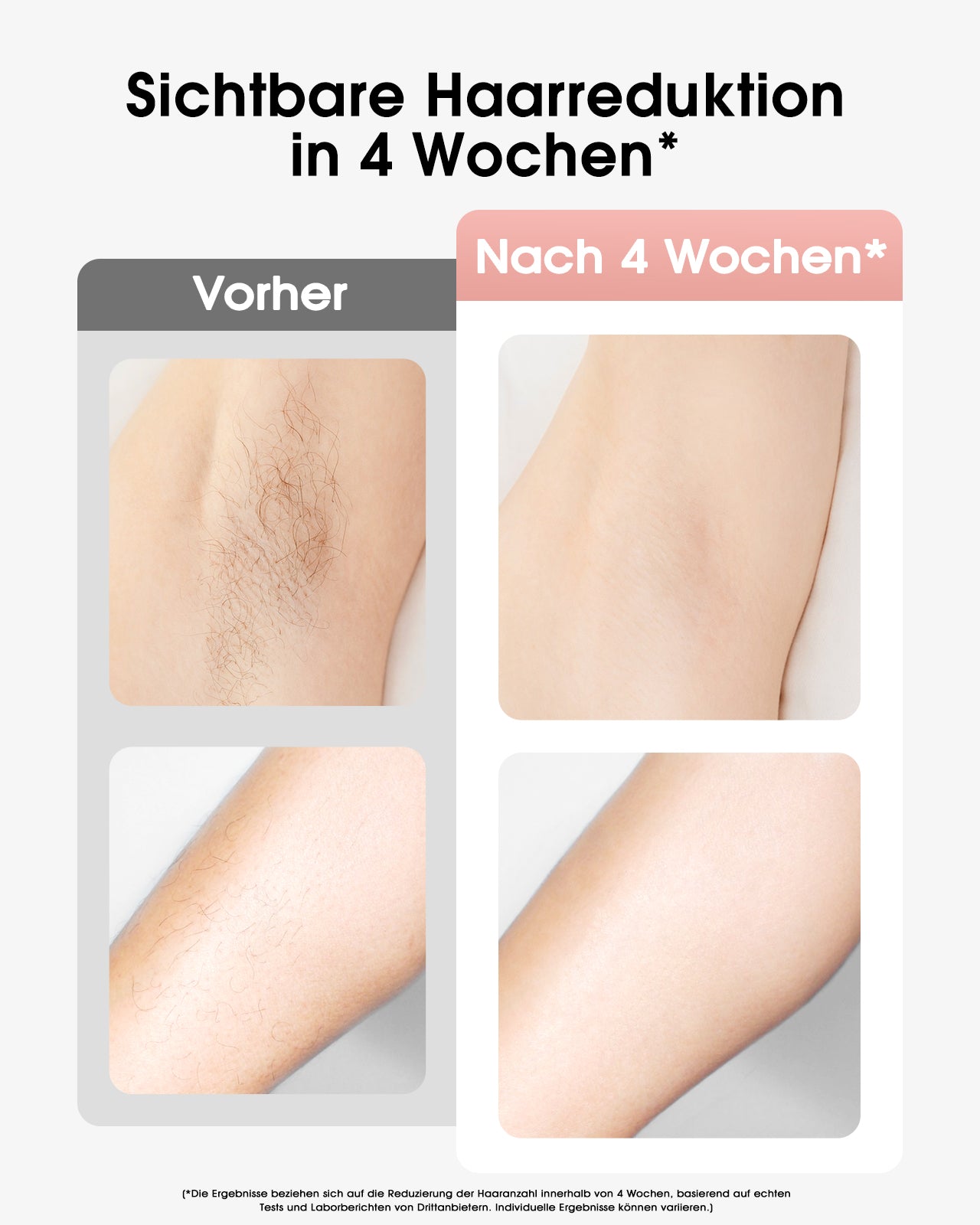Haarlosy IPL Geräte Haarentfernung mit Kühlfunktion, 999,900 Lichtimpulse, 5 Energiestufen Schmerzfreie IPL Haarentfernung Laser Hair Removal für Frauen, Männer, Intimbereich, Körper und Beine